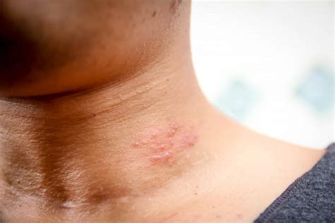 Beginning Stages Of Shingles On Neck
