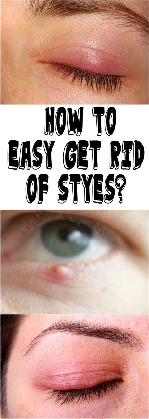 How To Easy Get Rid Of Styes