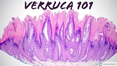 Wart Under Microscopeverruca 101 More Than You Ever Wanted To Know