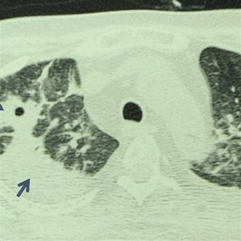 Contrast Ct Chest Showing Consolidation Nodules And Cavitation Of Upper