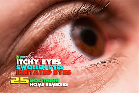 Red Itchy Eyes Home Remedies For Soothing Itchy Swollen Irritated