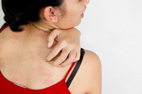 Skin Allergy Problem