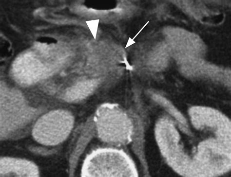 Intraductal Papillary Mucinous Neoplasms Of The Pancreas Ct Patterns