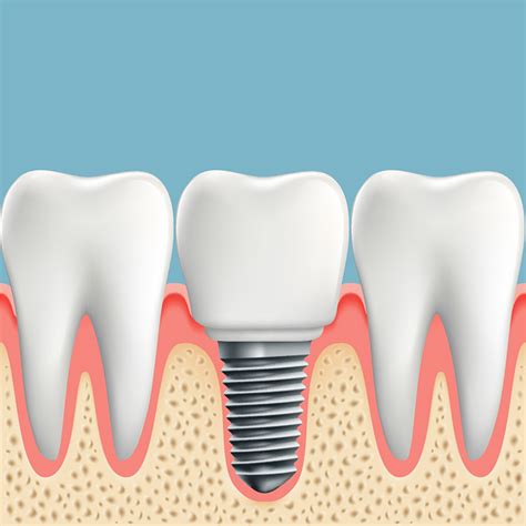 Your Intro To Dental Implants Knollwood Dental Care Dentist