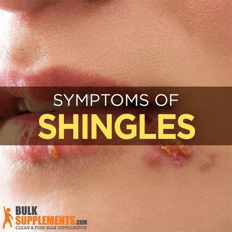 Shingles Adult Chickenpox Causes Symptoms And Treatment