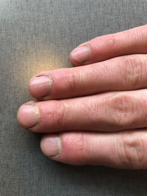 What Is Causing My Red Inflamed Looking Fingertips Had For Years Tips