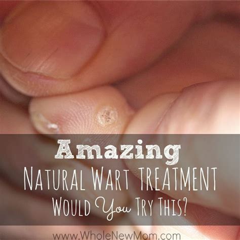 Natural Remedies For Warts Including A Crazy One That Really Works