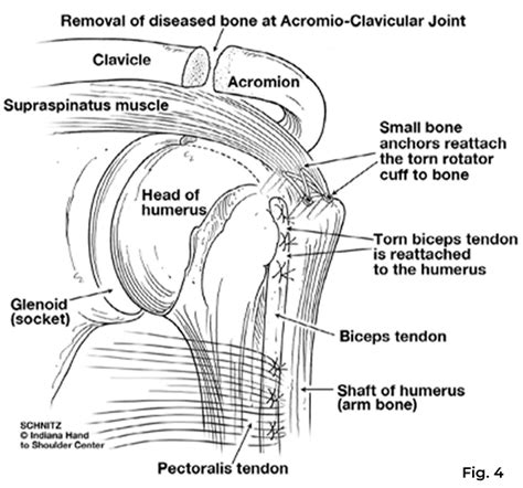 Shoulder Impingement Patient Education Ihtsc