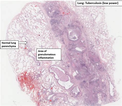 Tuberculosis Pathology