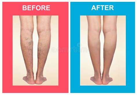 Treatment Of Varicose Before And After Varicose Veins On The Legs