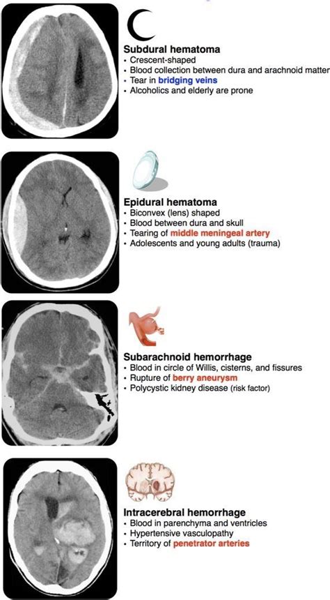 Types Of Cerebral Hemorrhage Medical School Studying Medical Anatomy