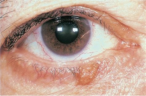 Classification And Management Of Eyelid Disorders Ento Key