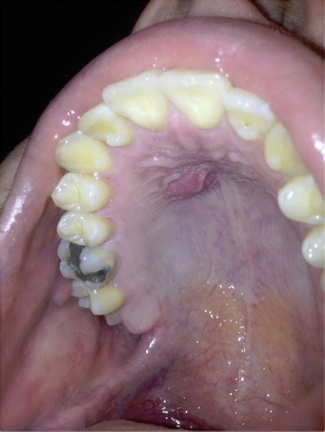 Lump On Roof Of Mouth Behind Front Teeth 12300 About Roof