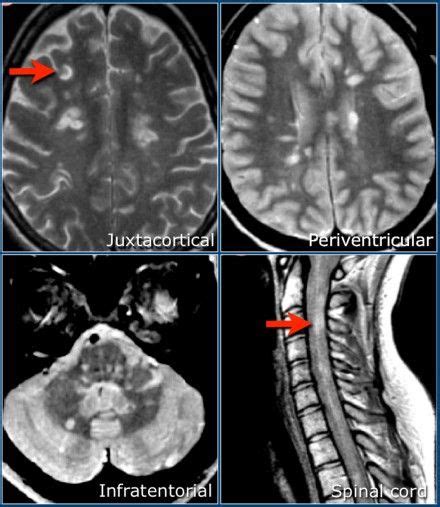 Zone Multiple Sclerosis Brain Lesions Demyelinating Disease