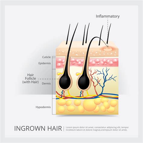 Ingrown Hair Structure Vector Illustration 538227 Vector Art At Vecteezy