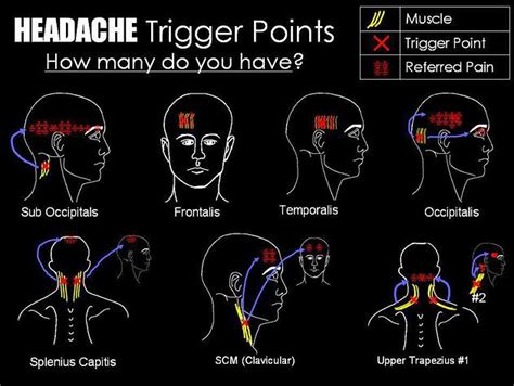 Trigger Point Headaches Energise Therapy