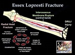 Fracture Of The Radial Head Essex Lopresti - Everything You Need To ...