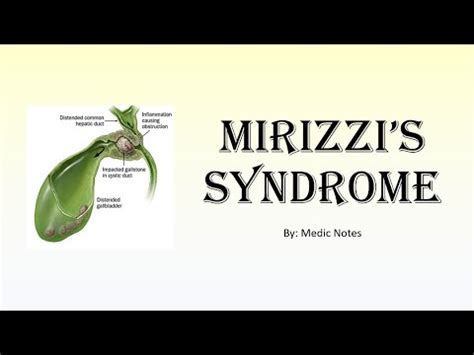 Mirizzi S Syndrome Definition Csendes Classification Treatment