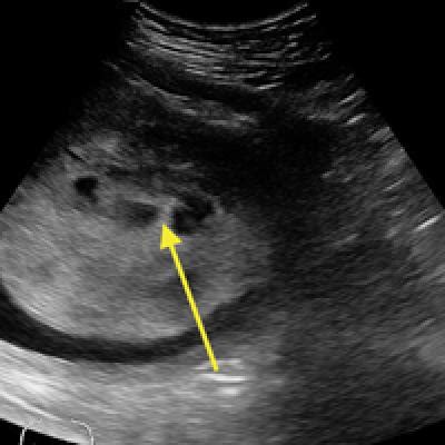 Diagnosis At A Glance Partial Hydatidiform Molar Pregnancy MDedge