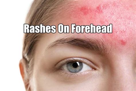 Rash On Forehead Does Affect The Beauty Of Your Face Read This
