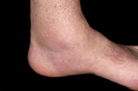 Gout Of The Ankle Photograph By Dr P Marazzi Science Photo Library