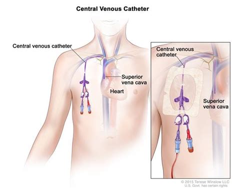 Central Venous Access Catheter CVC Central Venous Catheter Cancer Care Catheter