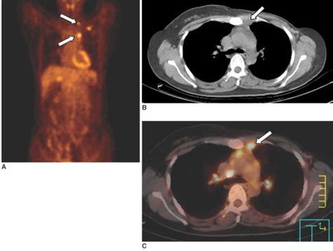 Mediastinal Lymph Node Metastasis In A 41 Year Old Woman Who Had