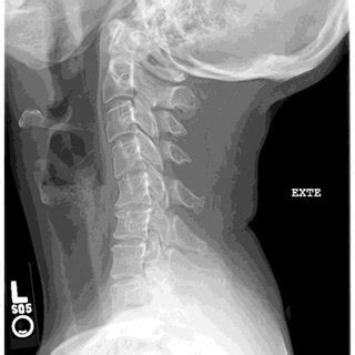 Cervical Spondylotic Myelopathy A Cervical Spine Mri Of A Year Old