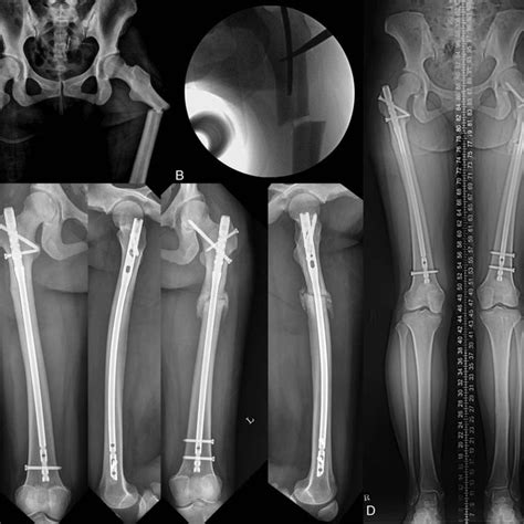 Atypical Femur Fracture Of The Patient A Preoperative Radiographs Of