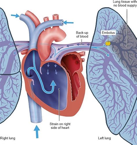 Pulmonary Embolism Informedhealth Org