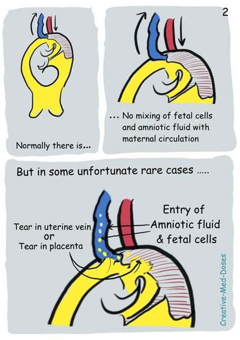 amniotic fluid embolism creative med doses