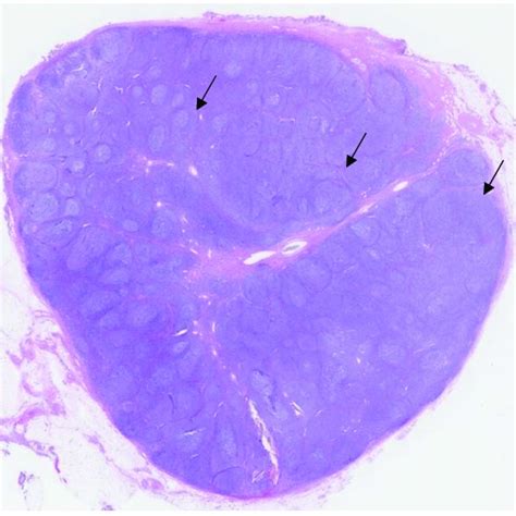 Immunohistochemistry Of Nodal Marginal Zone Lymphoma Marginal Zone