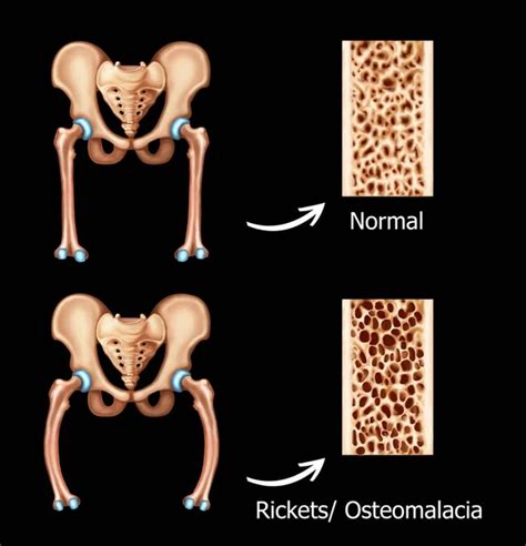 Rickets Osteomalacia Stock Photos Royalty Free Rickets Osteomalacia