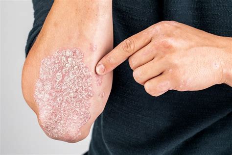 Five Ways To Manage Your Plaque Psoriasis Lux Dermatology Dermatologists