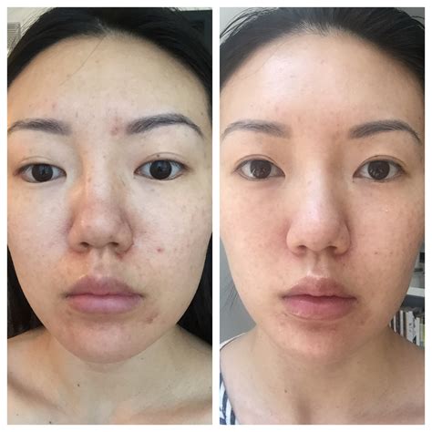 Microneedling With Prp Ipl Before And After Pics Blog Review