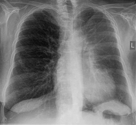 How Often Is Asbestosis Misdiagnosed As Chronic Bronchitis Shapiro Washburn Sharp
