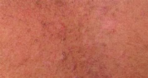 What Skin Cancer Looks Like Precancerous Skin Lesions And Skin Canc