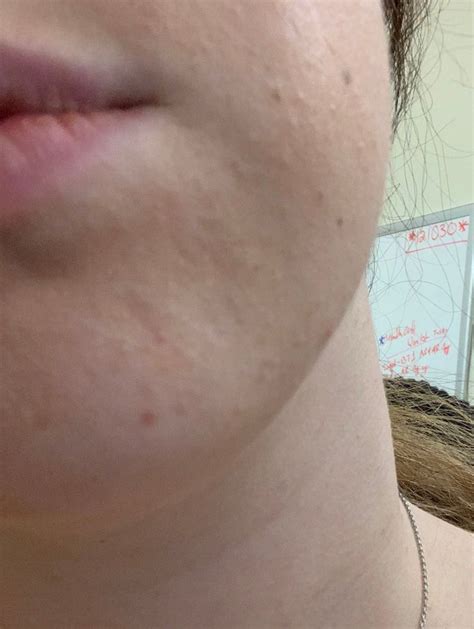 How To Get Rid Of Tiny Zit Like Bumps On Beauty Insider Community
