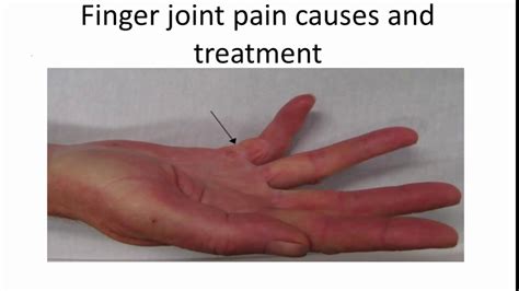 Ring Finger Left Hand Pain Beliebtester Schmuck