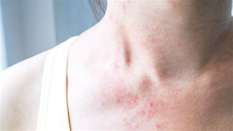 Eczema Vs Fungal Skin Infection Causes Differences Treatment