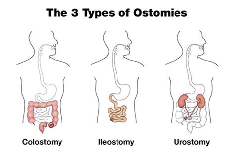 The 3 Types Of Ostomies Hollister Us Colostomy Ileostomy
