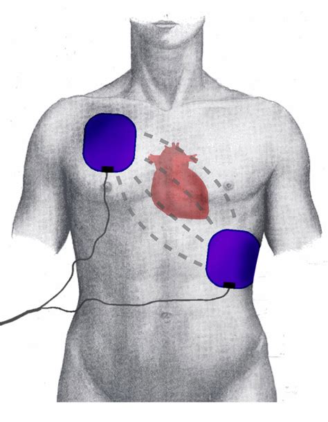 Defibrillation Treatment And Management Point Of Care