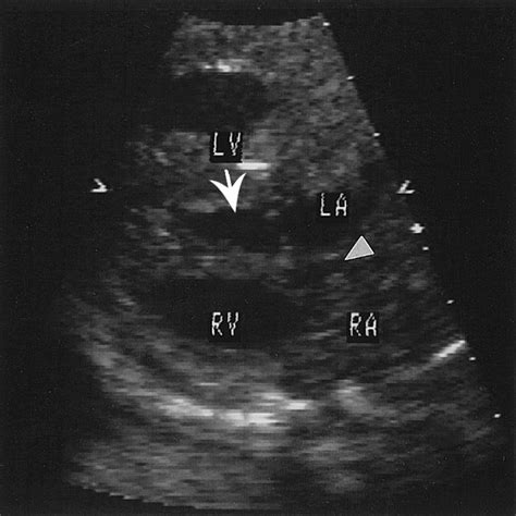 Hypoplastic Left Heart Syndrome Radiographics