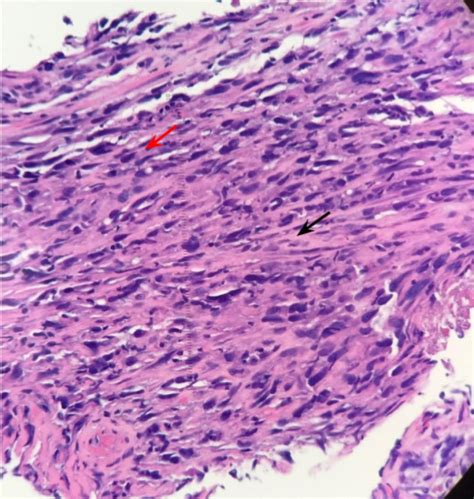 Cureus Acute Dysphagia Caused By Sarcomatoid Squamous Cell Carcinoma