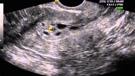 Hiperplasia Endometrial Adenomatosa Youtube