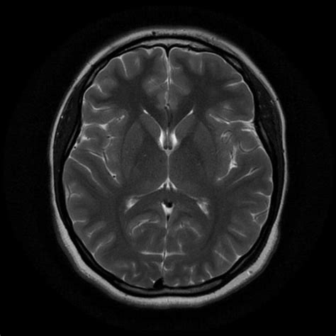Normal Brain Mri Radiology Case Mri Brain Mri