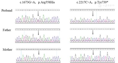 Compound Heterozygous Mutations In Wfs1 Cause Atypical Wolfram Syndrome Chinese Medical Journal