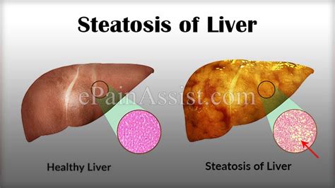 Steatosis Of Livercausessymptomstreatmentdietpathophysiology