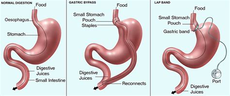 Are You A Bariatric Surgery Candidate Rex Bariatric Specialists