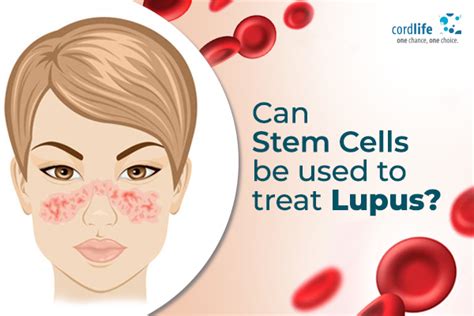 Can Stem Cells Be Used To Treat Lupus Cordlife India